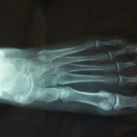 alluce rigido l'artrosi della articolazione dell'alluce