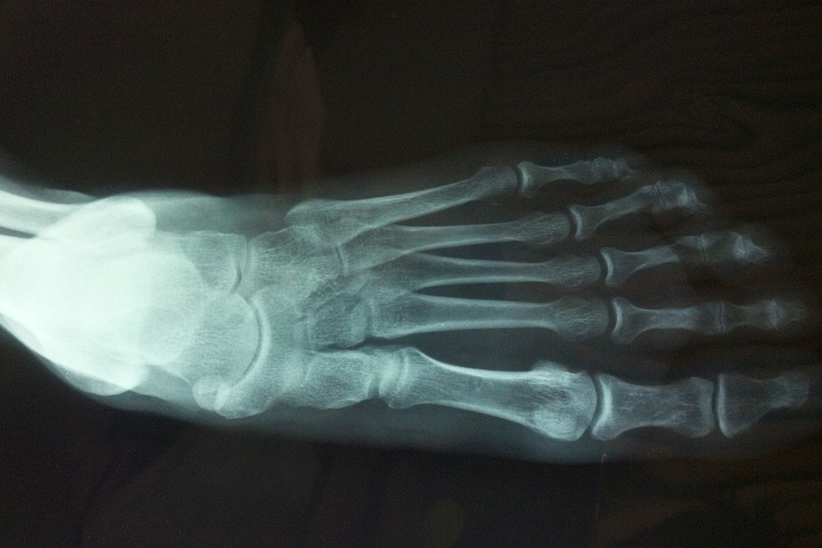 alluce rigido l'artrosi della articolazione dell'alluce